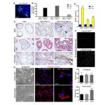 SOX9 is a driver of aggressive prostate cancer by promoting invasion, cell fate and cytoskeleton alt